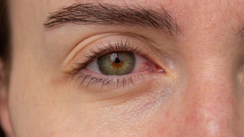 4 loại thuốc nhỏ mắt phổ biến giúp mau khỏi