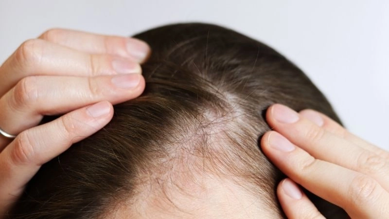 Dấu hiệu nhận biết da đầu đang dần suy kiệt