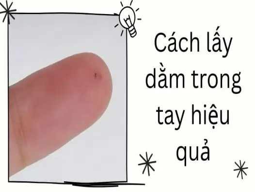 Cách lấy dằm trong tay hiệu quả, ai cũng có thể làm được