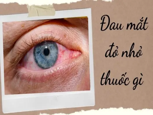 Đau mắt đỏ nhỏ thuốc gì để nhanh khỏi không tái phát