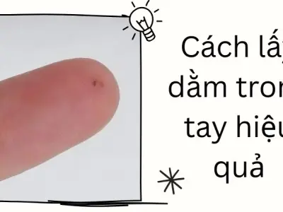 Cách lấy dằm trong tay hiệu quả, ai cũng có thể làm được